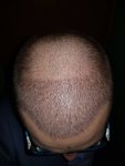 Dr. Bruno Ferreira FUE Hair Transplant.jpg