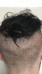 Dr Farjo FUE Hair Transplant.png Dr Farjo FUE Hair Transplant.png