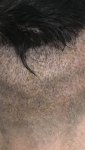 FUE at Farjo Hair Clinic.png FUE at Farjo Hair Clinic.png