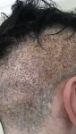 FUE with Dr Farjo.png FUE with Dr Farjo.png
