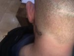 Hair transplant Turkey Dr Acar.JPG