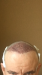 Hair transplant Turkey Dr Acar 2.PNG