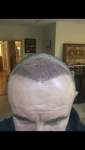 Hair transplant Turkey Cosmedica.PNG