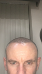 Cosmedica Hair Transplant Turkey.png