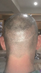 Dr Acar Cosmedica Hair transplant Turkey.png