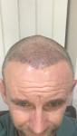 Hair transplant Turkey Cosmedica Dr Acar.png