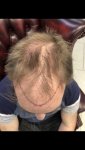 Dr Arshad before hair transplant.jpeg
