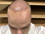 Dr Arshad after hair transplant.jpeg