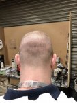 Dr Arshad Donor area after hair transplant.jpeg