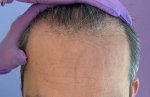 Dr Bicer Hair transplant Turkey.jpeg