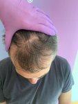 Dr Bicer Hair transplant Turkey 2.jpeg