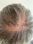 Dr Bicer Hair transplant Turkey 3.jpeg