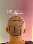 Dr Bicer Hair transplant Turkey 4.jpeg