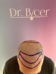 Dr Bicer Hair transplant Turkey 5.jpeg