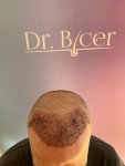 Dr Bicer Hair transplant Turkey 6.jpeg