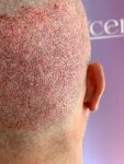 Dr Bicer Hair transplant Turkey 7.jpeg