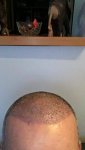 Dr Bicer Hair transplant Turkey 8.jpeg