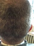 Dr Bicer Hair transplant Turkey 9.jpeg