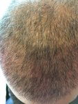 Dr Bicer Hair transplant Turkey 10.jpeg