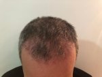 Dr Bicer Hair transplant Turkey 11.jpeg