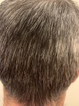 Dr Bicer Hair transplant Turkey 12.jpeg