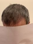 Dr Bicer Hair transplant Turkey 13.jpeg