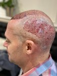The Hair Dr Leeds Hair Transplant 2.jpg