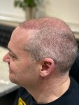 The Hair Dr Leeds Hair Transplant 4.jpg