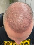 The Hair Dr Leeds Hair Transplant 5.jpg