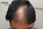 Dr Lupanzula hair transplant before.jpg