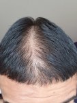 Dr Lupanzula hair transplant 1.jpg