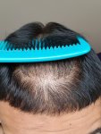 Dr Lupanzula hair transplant 2.jpg