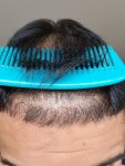 Dr Lupanzula hair transplant 3.jpg