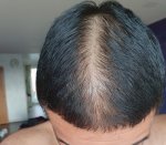 Dr Lupanzula hair transplant 4.jpg