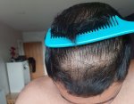 Dr Lupanzula hair transplant 5.jpg