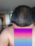 Dr Lupanzula hair transplant 6.jpg