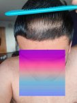 Dr Lupanzula hair transplant 7.jpg
