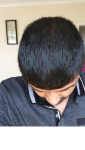 Medikemos hair transplant 5.png