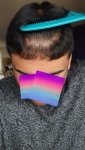 Medikemos hair transplant 6.jpg