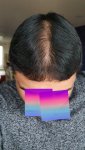Medikemos hair transplant 7.jpg