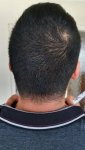 Medikemos hair transplant 1.jpg