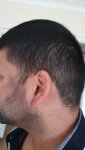 Medikemos hair transplant 2.jpg