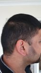 Medikemos hair transplant 3.jpg