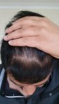Medikemos hair transplant 4.jpg