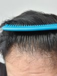 Medikemos hair transplant 1.jpg