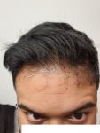 Medikemos hair transplant 2.png