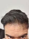 Medikemos hair transplant3.jpg