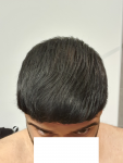 Medikemos hair transplant4.png