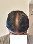 Medikemos hair transplant5.png