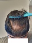 Medikemos hair transplant 6.jpg